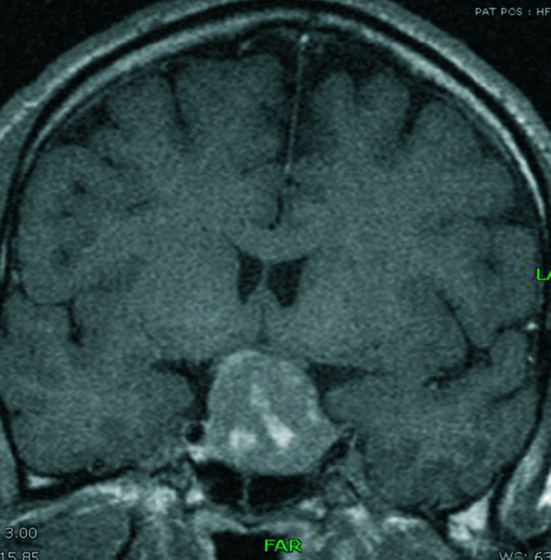 Vanishing hypercalciuric kidney stones after treating underlying acromegaly.
