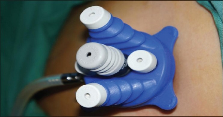Single incision laparoscopic surgery for a large endometriotic cyst.