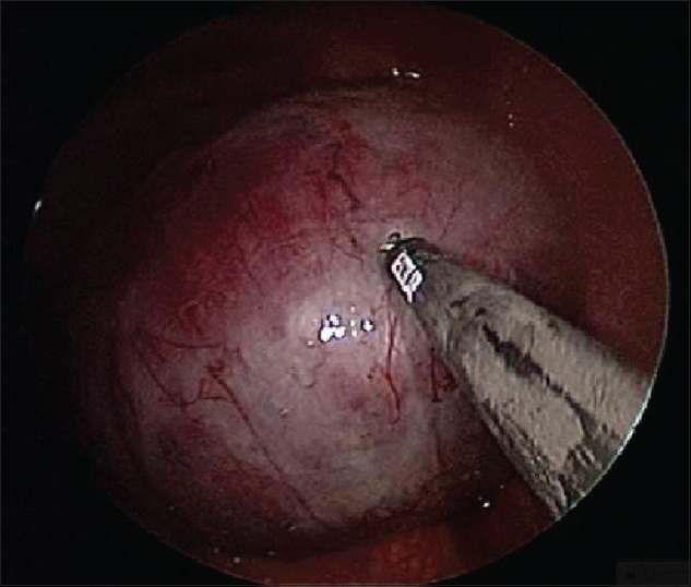 Single incision laparoscopic surgery for a large endometriotic cyst.
