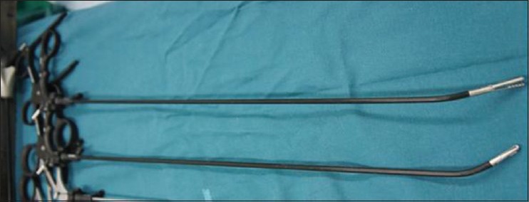 Single incision laparoscopic surgery for a large endometriotic cyst.