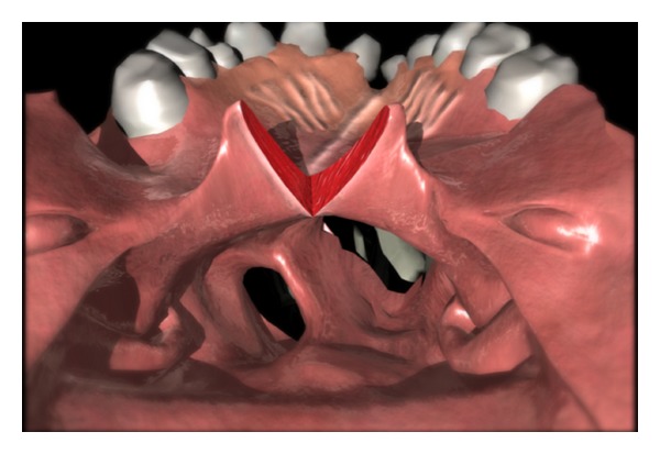 The lateral port control pharyngeal flap: a thirty-year evolution and followup.