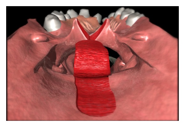 The lateral port control pharyngeal flap: a thirty-year evolution and followup.