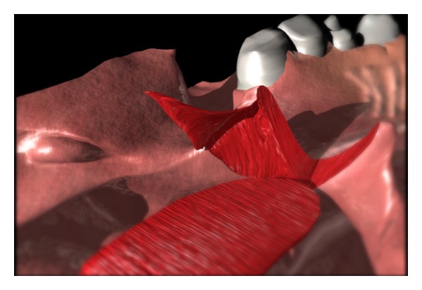 The lateral port control pharyngeal flap: a thirty-year evolution and followup.