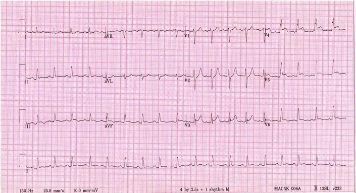 A silent myocardial infarction in the diabetes outpatient clinic: case report and review of the literature.