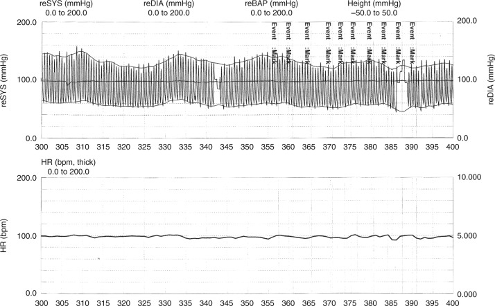 A silent myocardial infarction in the diabetes outpatient clinic: case report and review of the literature.