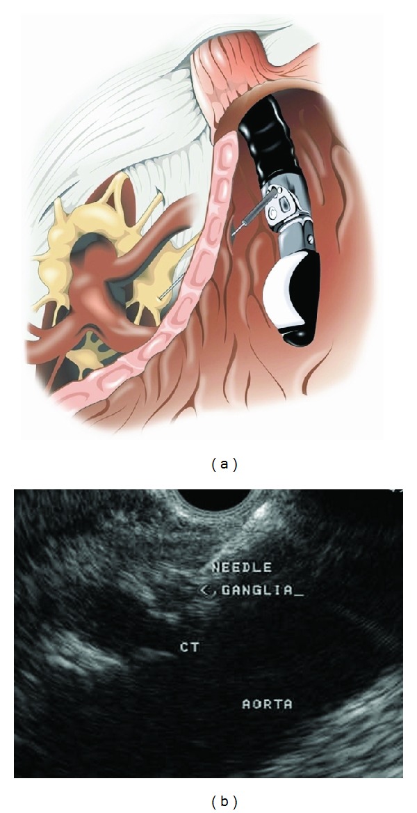 Endoscopic Ultrasound-Guided Celiac Plexus Neurolysis in Pancreatic Cancer: A Prospective Pilot Study of Safety Using 10 mL versus 20 mL Alcohol.