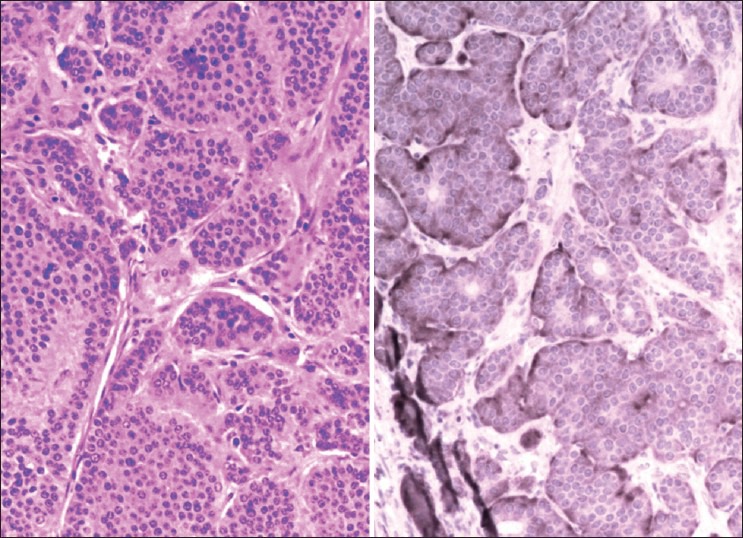 Carcinoid Tumor in Accidental, Asymptomatic Meckel's Diverticulum.