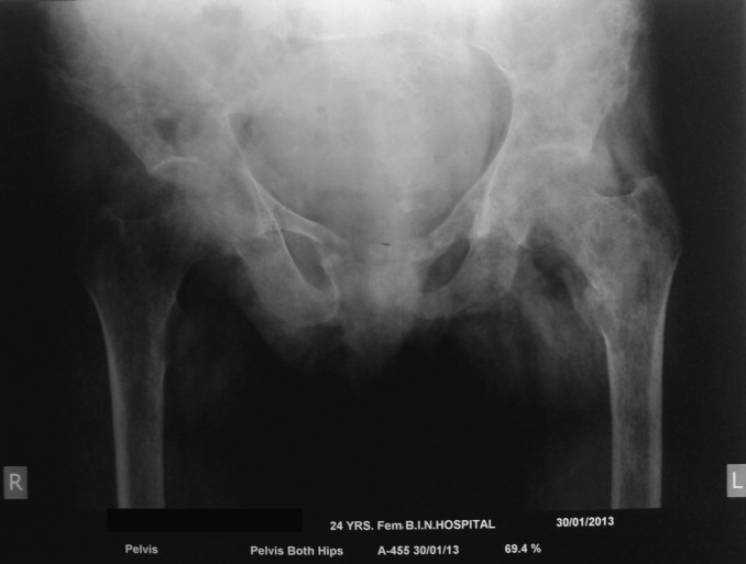 Needle aspirate PTH in diagnosis of primary hyperparathyroidism due to intrathyroidal parathyroid cyst.