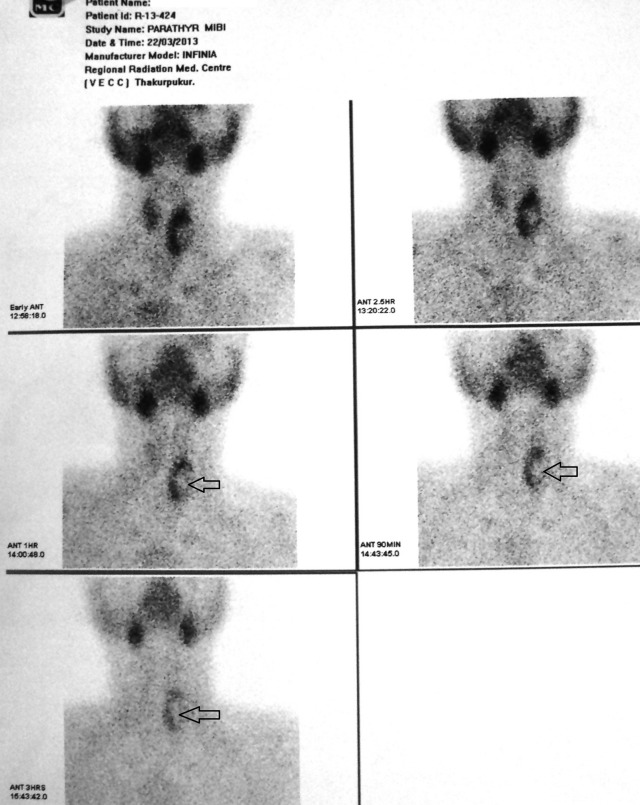 Needle aspirate PTH in diagnosis of primary hyperparathyroidism due to intrathyroidal parathyroid cyst.
