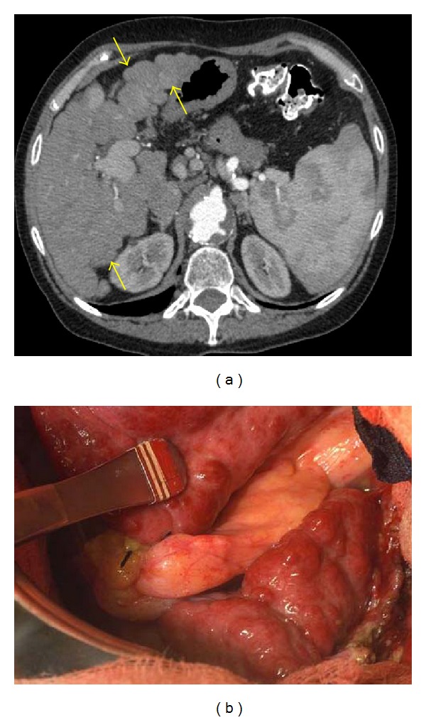 MDCT Imaging Findings of Liver Cirrhosis: Spectrum of Hepatic and Extrahepatic Abdominal Complications.