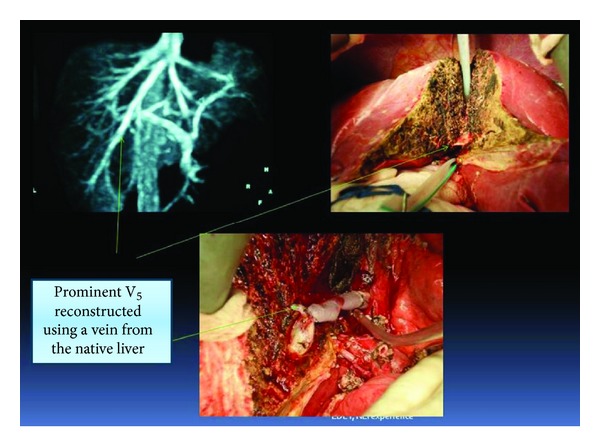 Venous Outflow Reconstruction in Adult Living Donor Liver Transplant: Outcome of a Policy for Right Lobe Grafts without the Middle Hepatic Vein.