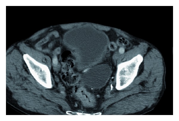 Strategies to evaluate synchronous carcinomas of the colon and rectum in patients that present for emergent surgery.