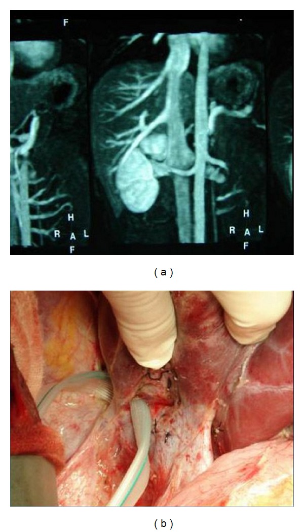 Venous Outflow Reconstruction in Adult Living Donor Liver Transplant: Outcome of a Policy for Right Lobe Grafts without the Middle Hepatic Vein.