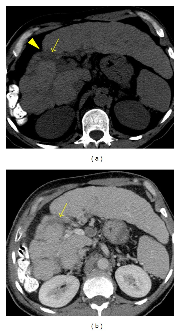 MDCT Imaging Findings of Liver Cirrhosis: Spectrum of Hepatic and Extrahepatic Abdominal Complications.