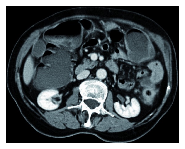 Strategies to evaluate synchronous carcinomas of the colon and rectum in patients that present for emergent surgery.