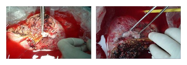 Venous Outflow Reconstruction in Adult Living Donor Liver Transplant: Outcome of a Policy for Right Lobe Grafts without the Middle Hepatic Vein.