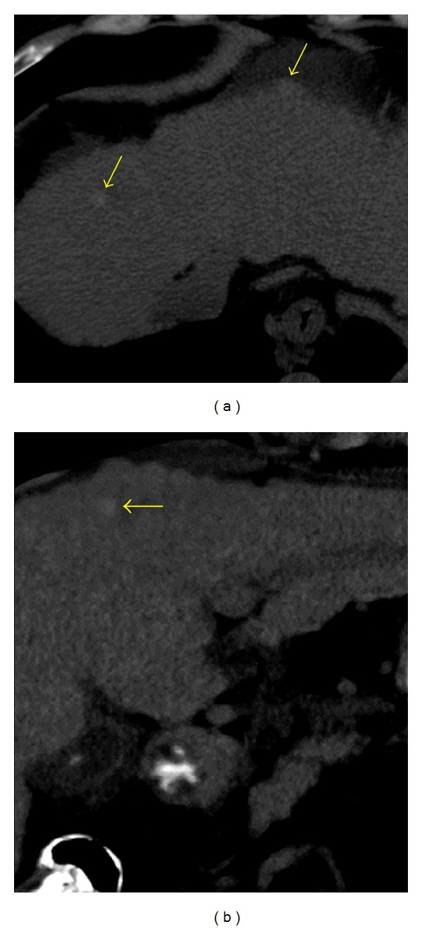 MDCT Imaging Findings of Liver Cirrhosis: Spectrum of Hepatic and Extrahepatic Abdominal Complications.