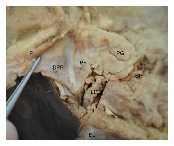 The superficial musculoaponeurotic system of the face: a model explored.