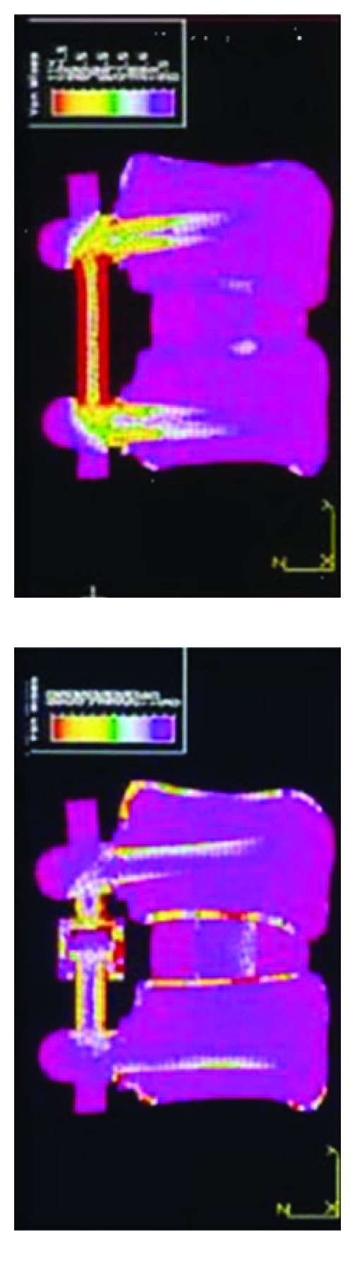 Pedicle-Screw-Based Dynamic Systems and Degenerative Lumbar Diseases: Biomechanical and Clinical Experiences of Dynamic Fusion with Isobar TTL.