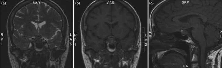 Pituitary metastases from papillary carcinoma of thyroid: a case report and literature review.