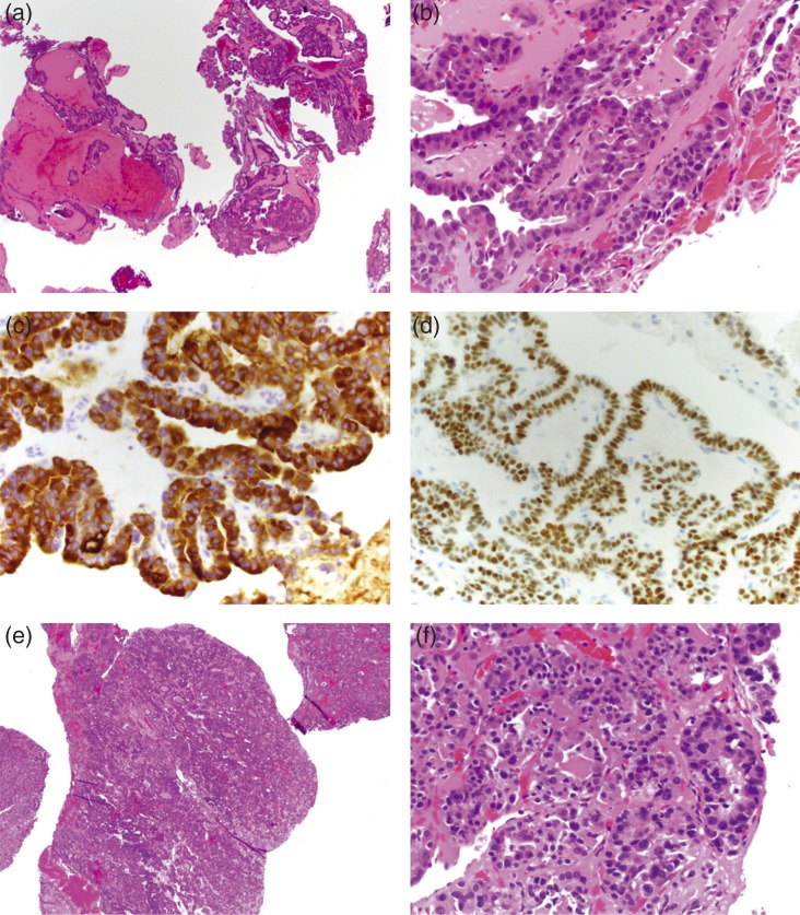 Pituitary metastases from papillary carcinoma of thyroid: a case report and literature review.