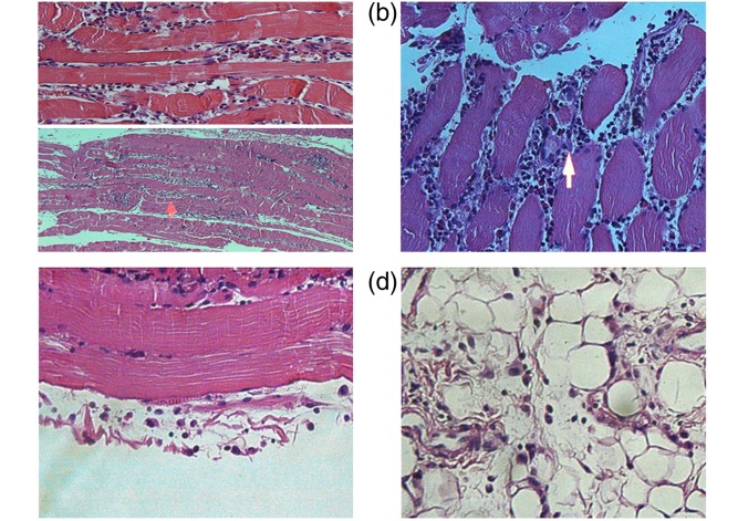 Methimazole-induced myositis: a case report and review of the literature.