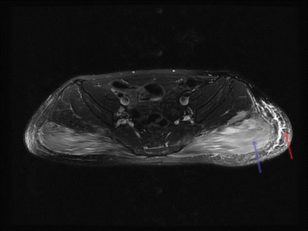 Methimazole-induced myositis: a case report and review of the literature.