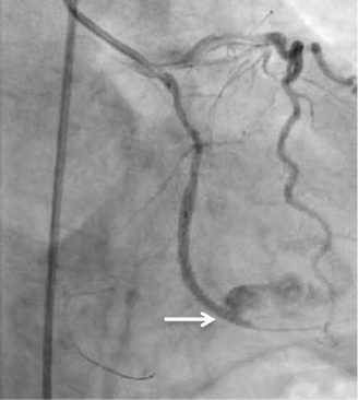 Coronary Perforation Complicating Percutaneous Coronary Intervention - A Case Illustration and Review.