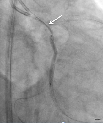 Coronary Perforation Complicating Percutaneous Coronary Intervention - A Case Illustration and Review.