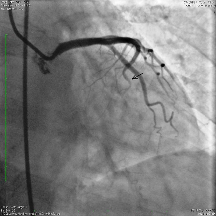 Rosuvastatin was Effective in Acute Heart Failure and Slow Coronary Flow: A Hypothesis-generating Case Report.