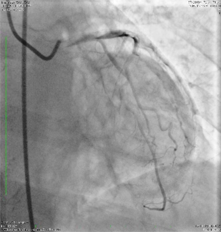 Rosuvastatin was Effective in Acute Heart Failure and Slow Coronary Flow: A Hypothesis-generating Case Report.