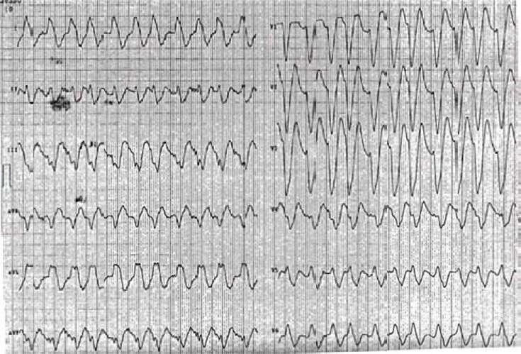 Rosuvastatin was Effective in Acute Heart Failure and Slow Coronary Flow: A Hypothesis-generating Case Report.