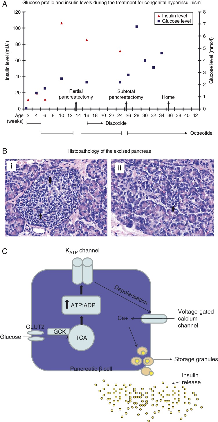 Paternally inherited ABCC8 mutation causing diffuse congenital hyperinsulinism.