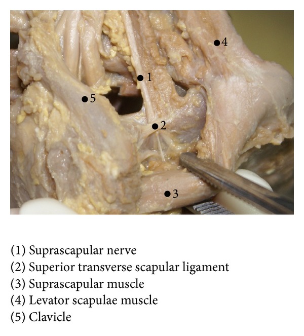The superior transverse scapular ligament in fetuses.