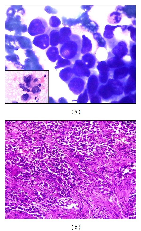 Comparative Study of Cytomorphological Robinson's Grading for Breast Carcinoma with Modified Bloom-Richardson Histopathological Grading.