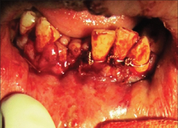 Bone suture in management of mandibular degloving injury.