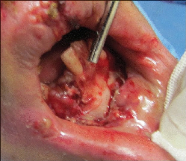 Bone suture in management of mandibular degloving injury.