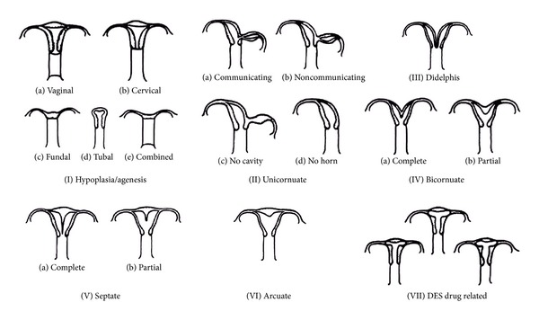 Mayer-rokitansky-kuster-hauser syndrome: embryology, genetics and clinical and surgical treatment.