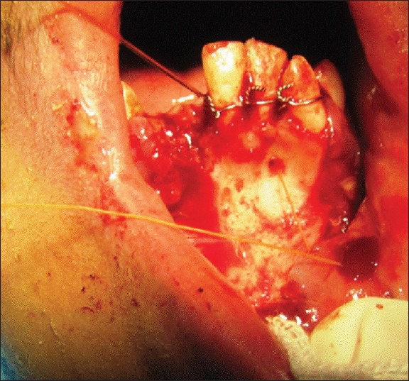 Bone suture in management of mandibular degloving injury.