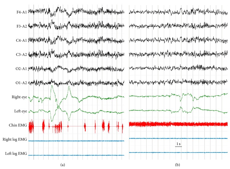 Sleep-Wake Cycle and Daytime Sleepiness in the Myotonic Dystrophies.