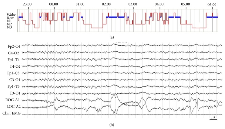 Sleep-Wake Cycle and Daytime Sleepiness in the Myotonic Dystrophies.