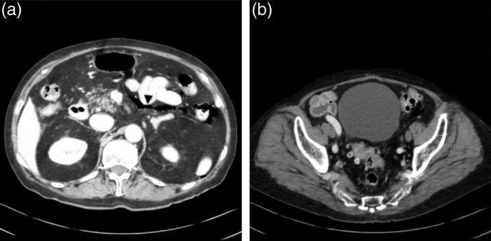 Cushing's disease presenting with gastrointestinal perforation: a case report.