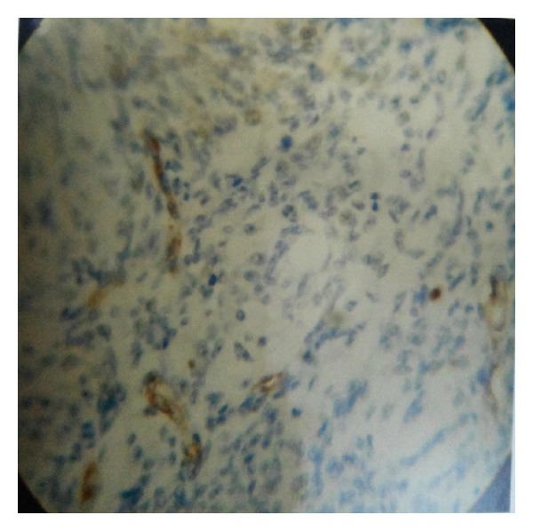 Diagnostic Modalities of Precancerous and Cancerous Cervical Lesions with Special Emphasis on CD31 Angiogenesis Factor as a Marker.