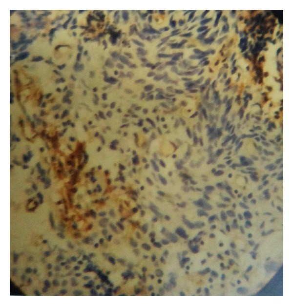 Diagnostic Modalities of Precancerous and Cancerous Cervical Lesions with Special Emphasis on CD31 Angiogenesis Factor as a Marker.