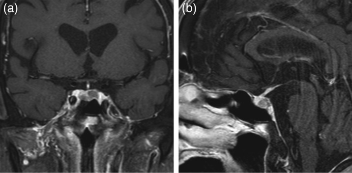 Cushing's disease presenting with gastrointestinal perforation: a case report.