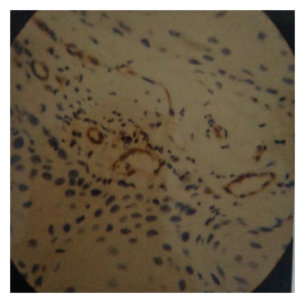 Diagnostic Modalities of Precancerous and Cancerous Cervical Lesions with Special Emphasis on CD31 Angiogenesis Factor as a Marker.