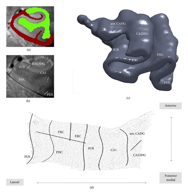 Cardiovascular risk and hippocampal thickness in Alzheimer's disease.