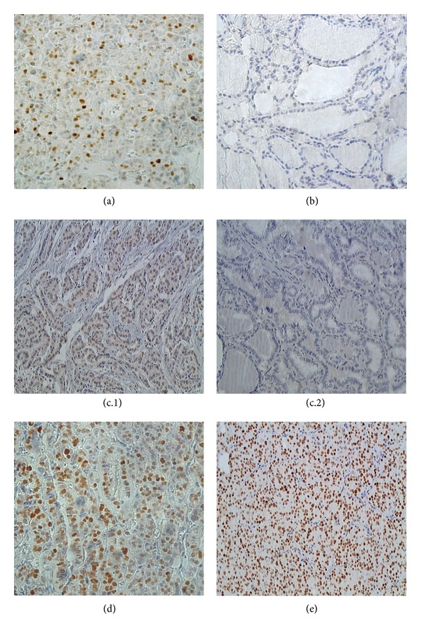 P53 and expression of immunological markers may identify early stage thyroid tumors.