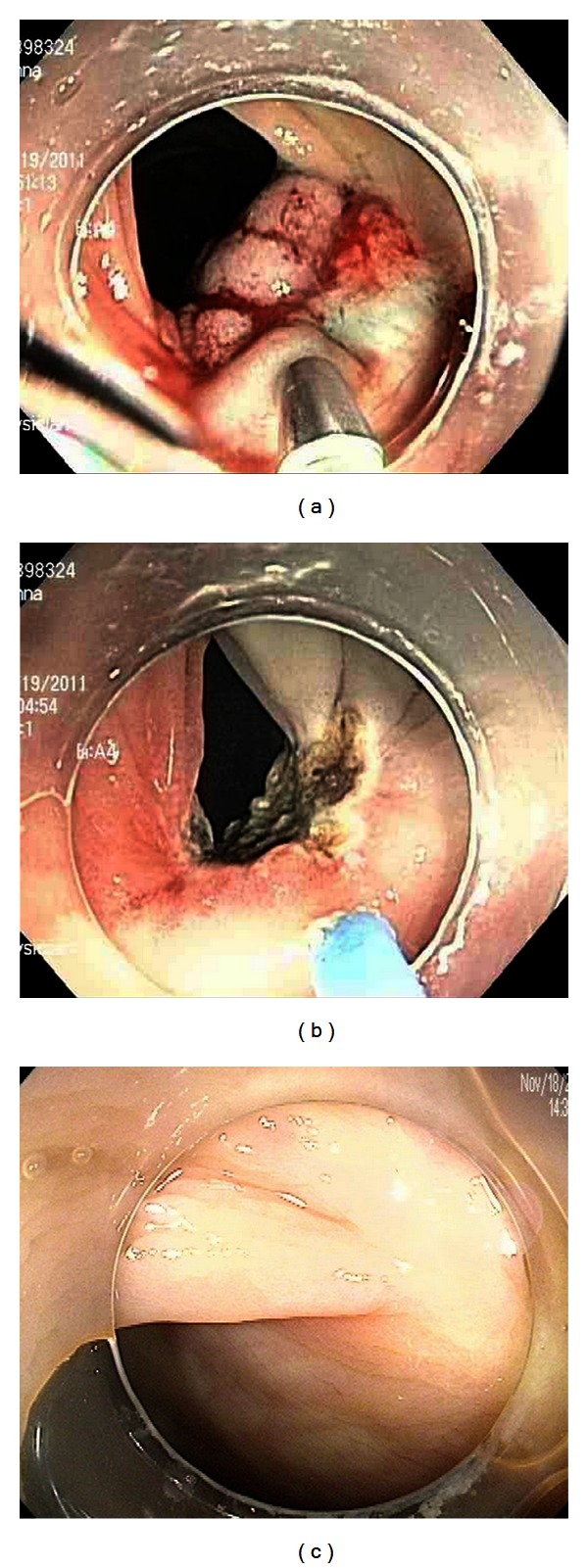 Endoscopic management of nonlifting colon polyps.