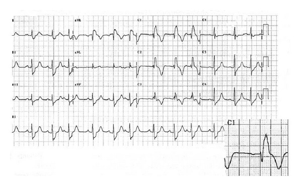 QRS Complex Enlargement as a Predictor of Ventricular Arrhythmias in Patients Affected by Surgically Treated Tetralogy of Fallot: A Comprehensive Literature Review and Historical Overview.